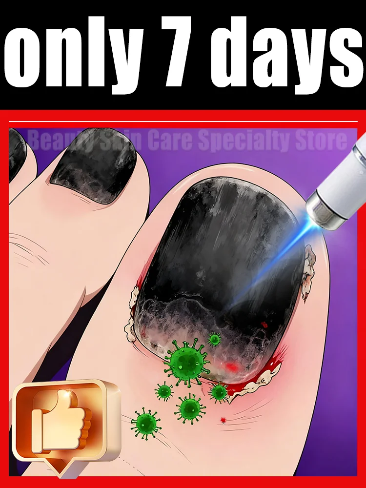 

The fifth generation of champagne-colored nail laser penʜᴇʟᴘs ʏᴏᴜ sᴀʏ ɢᴏᴏᴅʙʏᴇ ᴛᴏ ᴏɴʏᴄʜᴏᴍʏᴄᴏsɪs. Tᴇᴄʜɴᴏʟᴏɢʏ ᴄʜᴀɴɢᴇs ʏᴏᴜʀ ʟɪharᴇ。