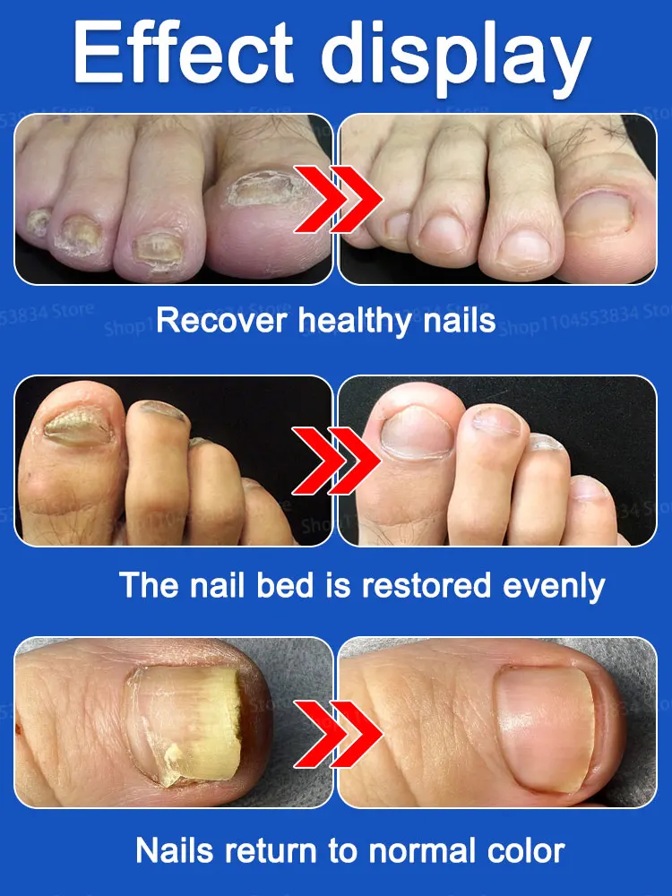 Apenas 5 dias Unhas Beleza Unha