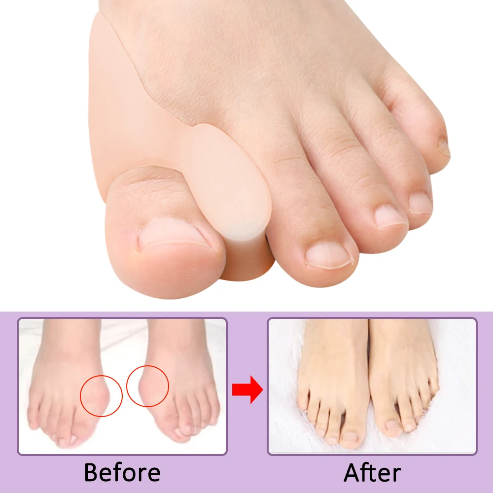 Pexmen 2Pcs Gel Big Toe Bunion Pads Guards Toe Separator Protectors for Crooked Overlapping Toes Corrector Shield Spacer