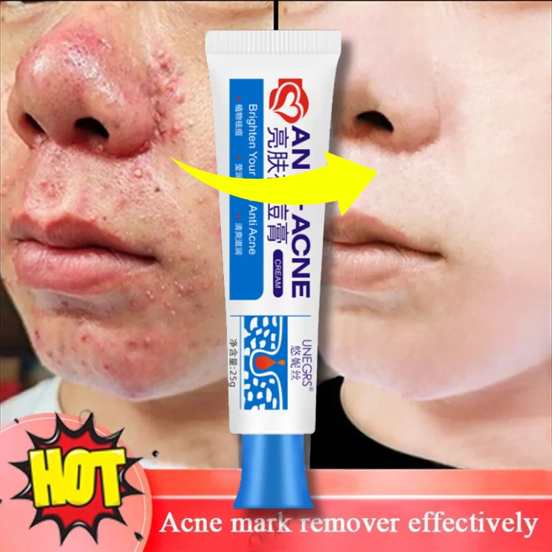 

Acne Removal Face Herbal Cream Clears Pimple Scar Black Dots Gel Acne Treatment Shrink Pore Skin Whitening Lightening Ointment
