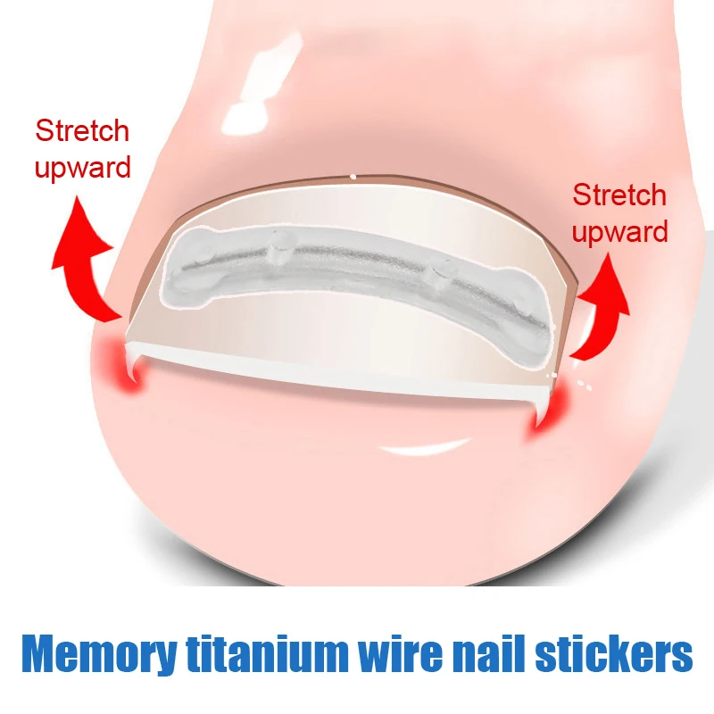 رقع تصحيح أظافر القدم الناشئة ، ملصقات تصحيح الأظافر ، علاج البارونيشيا ، أدوات التعافي ، أدوات العناية بالأقدام ، 13-19 ، 25 ، 30