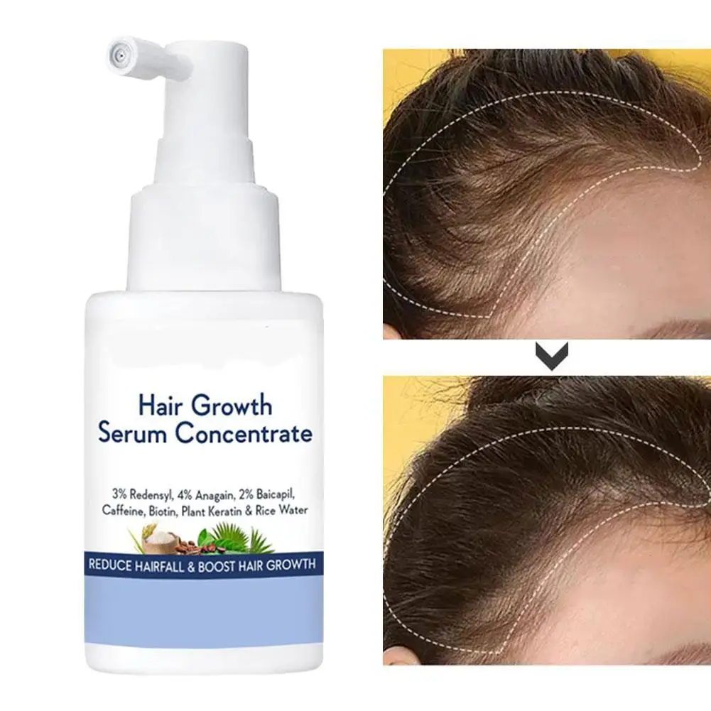 

Hair Increasing Spray Powerful Anti Hair Loss Treatment Repair Damaged Nourish Scalp Hair Care Products