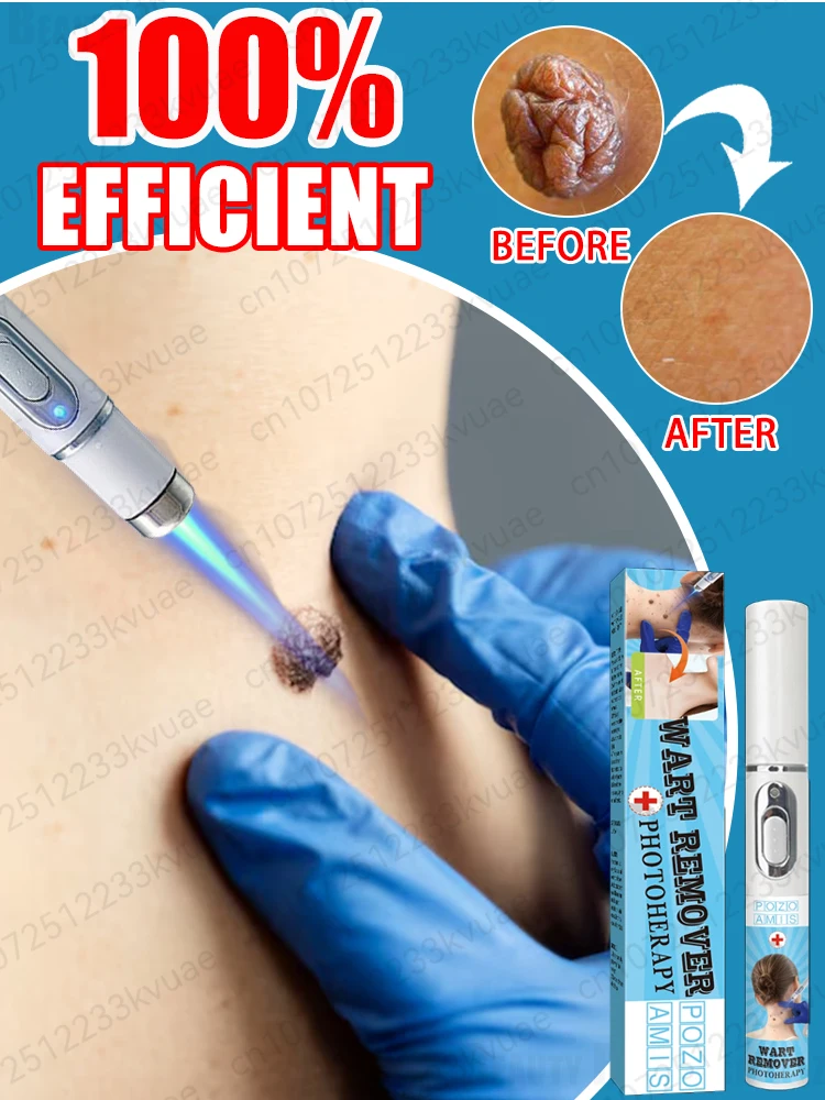 تفكيك عميق للثآليل وسقوطون بشكل طبيعي خلال 7 أيام دون ترك أي علامات