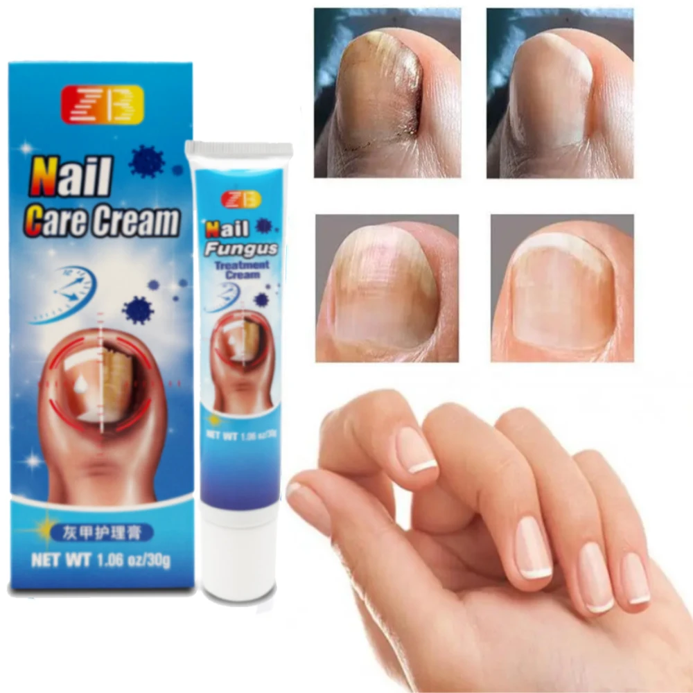 30g Nail Fungal Treatment Ointment YG-447
