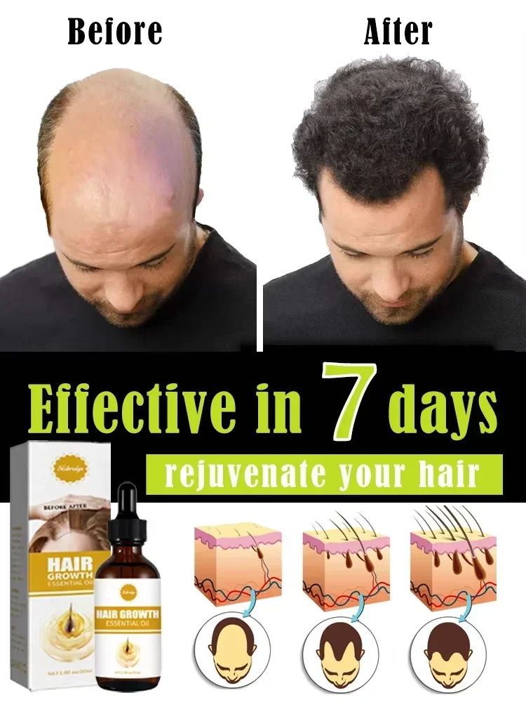 

O óleo de crescimento capilar faz o cabelo crescer rapidamente, repara eficazmente a calvície e a queda de cabelo hereditária