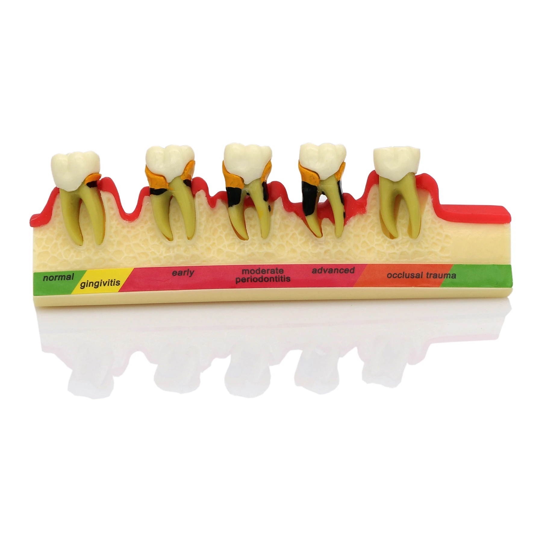 Dental Teeth Model 5 Stages Periodontitis Progress Periodontal Disease Model Gingivitis Teaching Model For Patient Education