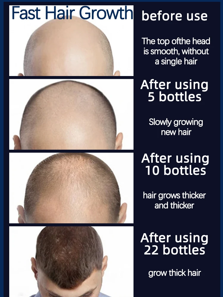De haargroeiproducten kunnen de hoofdhuid penetreren, wees gerapporteert de haargroei en herstelt het verloren haar
