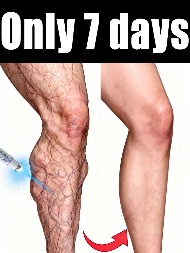 

Free Shipping! 2025 Bestselling 7-Day Varicose Vein Care Product