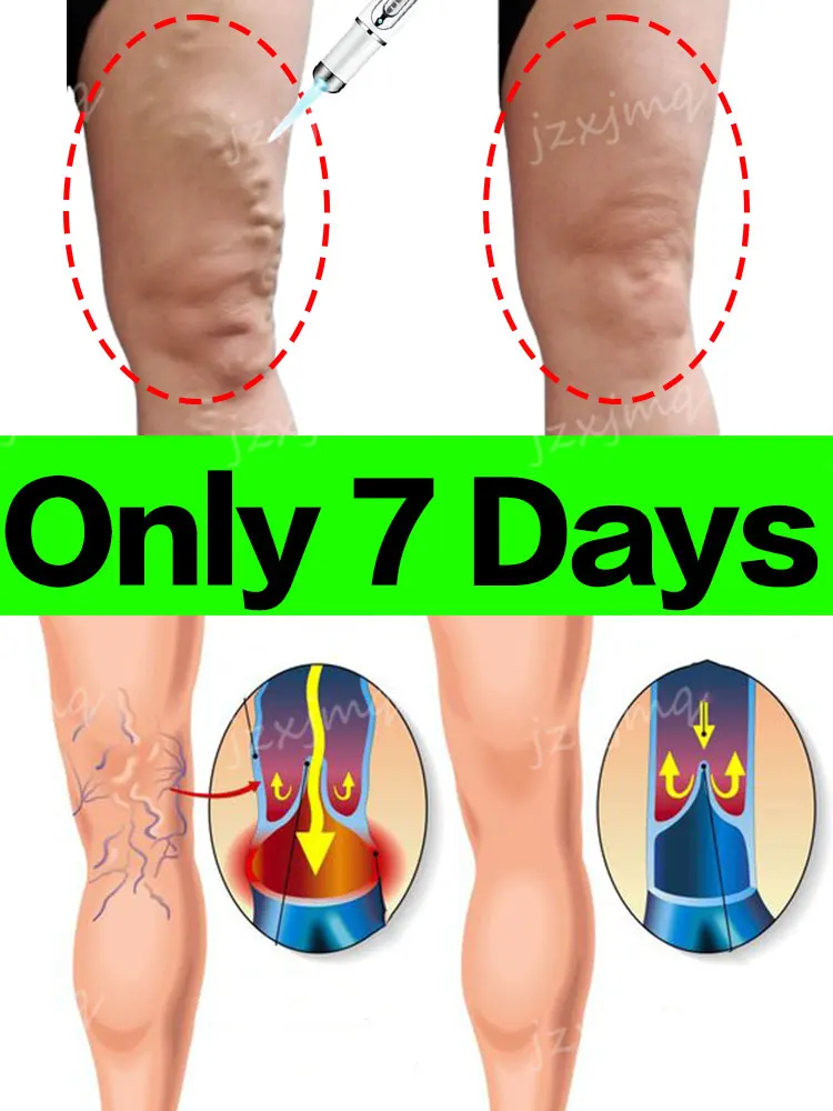 

Laser Relief Of Varicose Veins Vasculitis Phlebitis Spider Leg Soothing