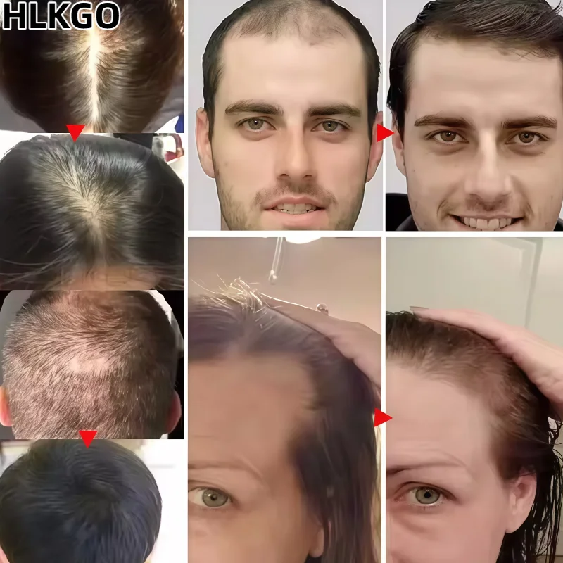 

Лазерный шлем против выпадения волос для мужчин, шапочка для роста волос для роста волос и ухода за кожей головы