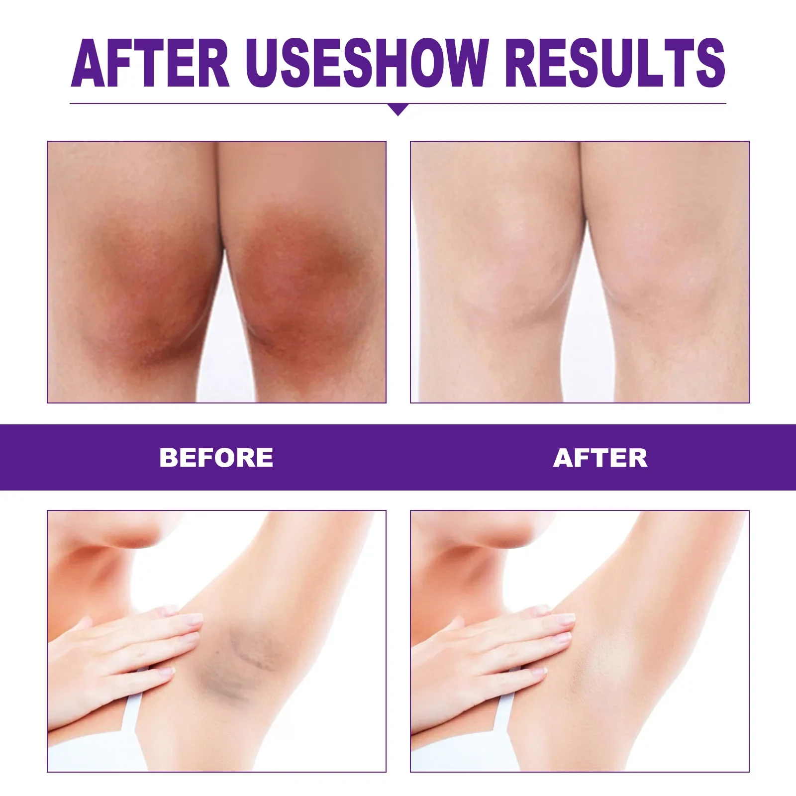 Women Cream Remove Melanin Emulsion Brighten Inner Thigh Whiten Butt Knee  Private Parts Underarm Bleaching Serum Coolant