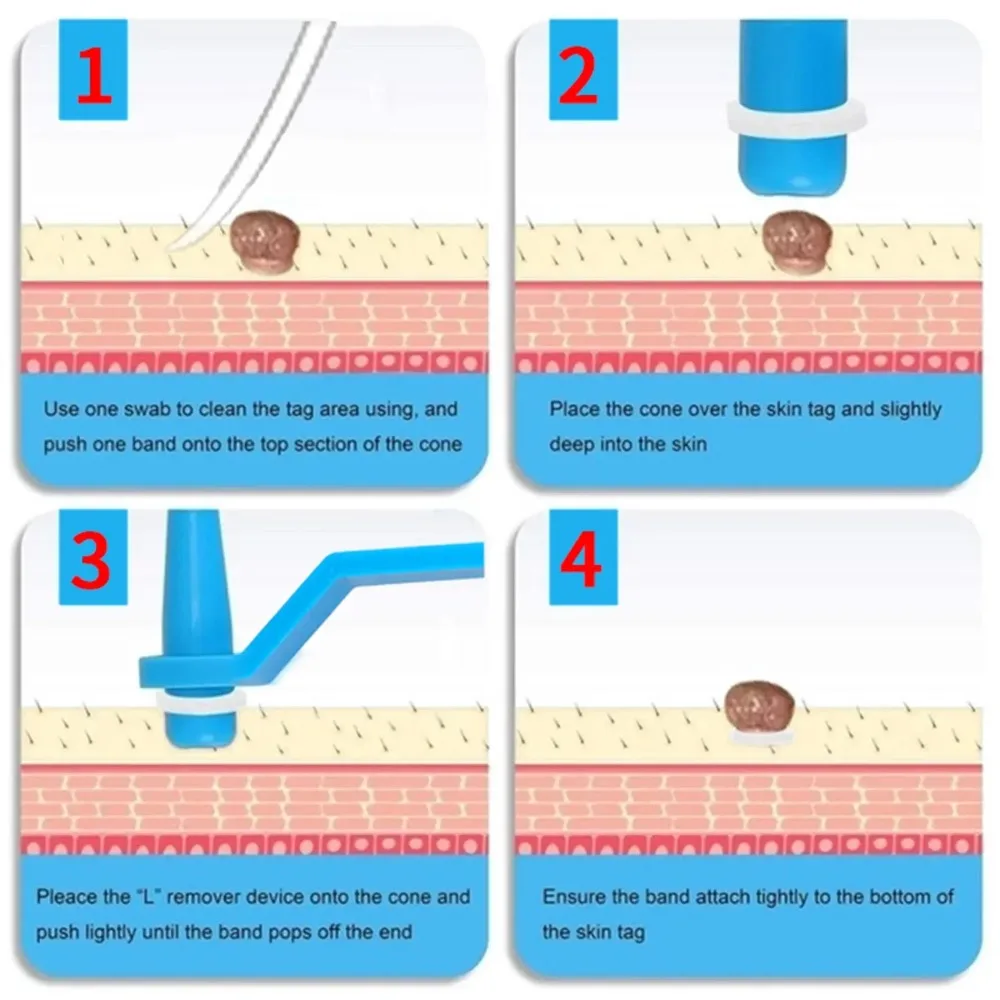 20 ชิ้น 1-4 มิลลิเมตร/5-8 มิลลิเมตรลบแท็กผิวหดสุขภาพความงาม Skin Care เครื่องมือแหวนยางปลอดสารพิษ: Removal Mole Wart Removal