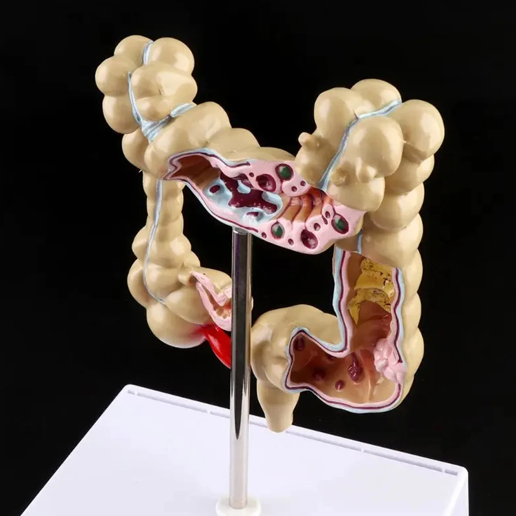 

Human Colorectal Lesion Model Pathological Anatomy Colon Diseases Intestine Medical Teaching Learning Science Education Tool ﻿