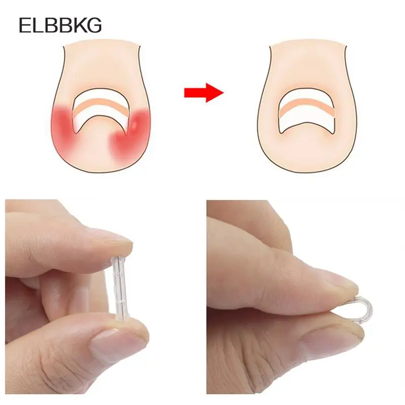 10pc/box Ingrown Toenail Correction Tool Ingrown Toe Nail Treatment Elastic Patch Sticker Straightening Clip Brace Pedicure Tool