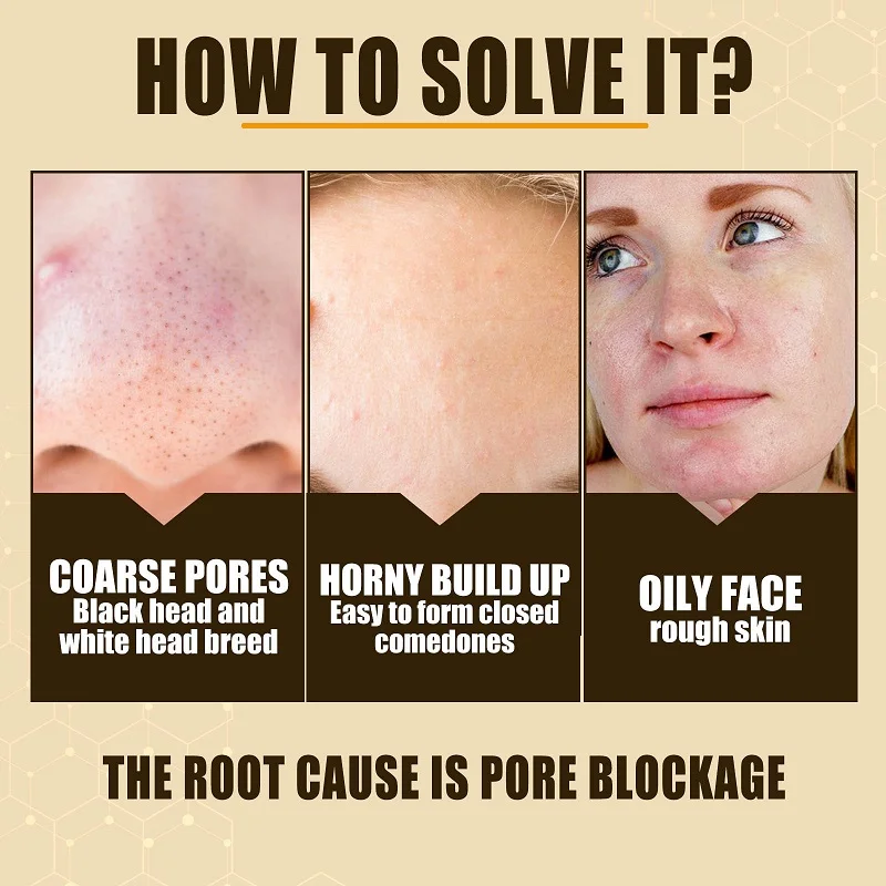 Essence de réduction des pores remodelée, points noirs, marques d'acné, prévention des pores élargis, réparation de la peau du visage, hydratant, soins de la peau