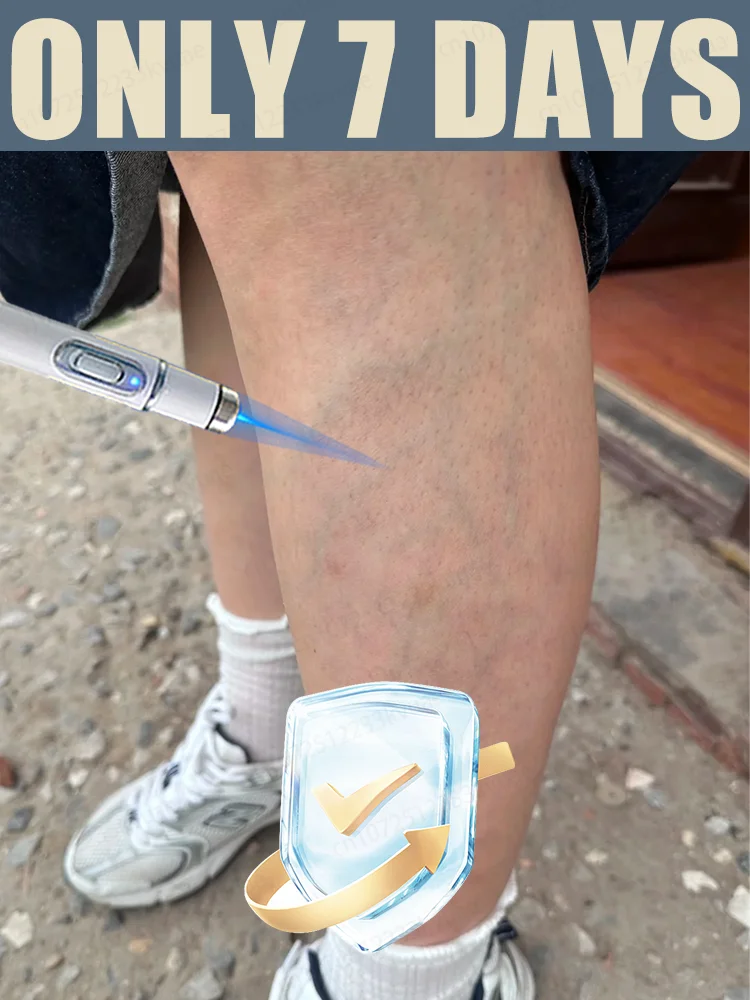 

blue light pen solve varicose veins, hot sale leg care tools