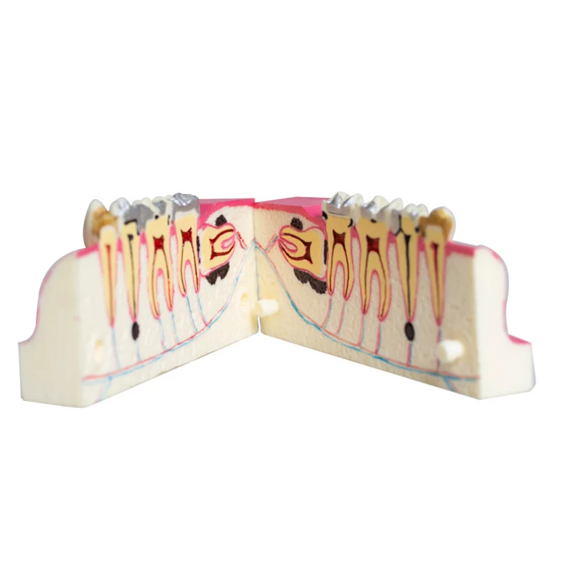Posterior tooth section demonstration model, dental tissue anatomical model with damage display, dental teaching model