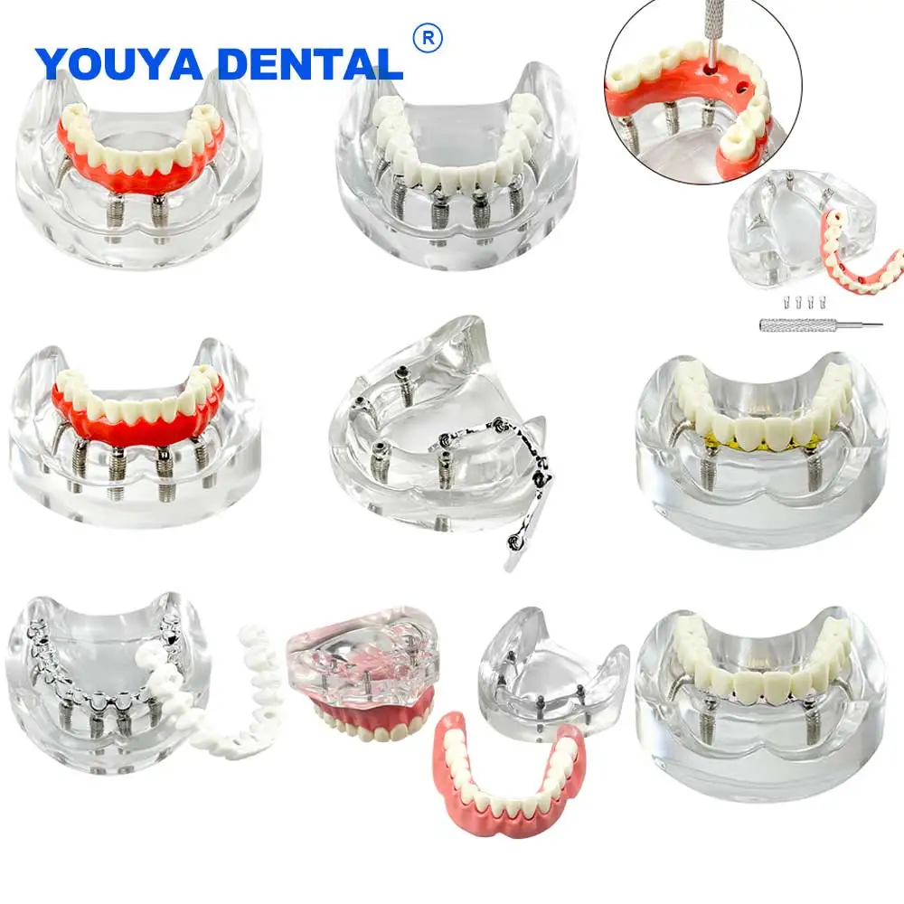 

Стоматологическая модель зубов, 2 имплантаты, демонстрационная модель 6002, съемная реставрационная стоматологическая студенческая обучающая нижняя модель