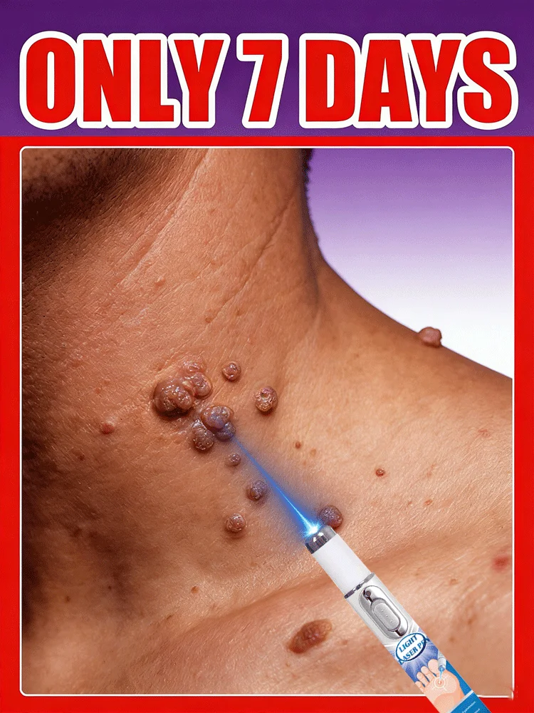 

Инструмент для удаления бородавок синим светом, легко чистящийся инструмент для ухода за кожей, унисекс