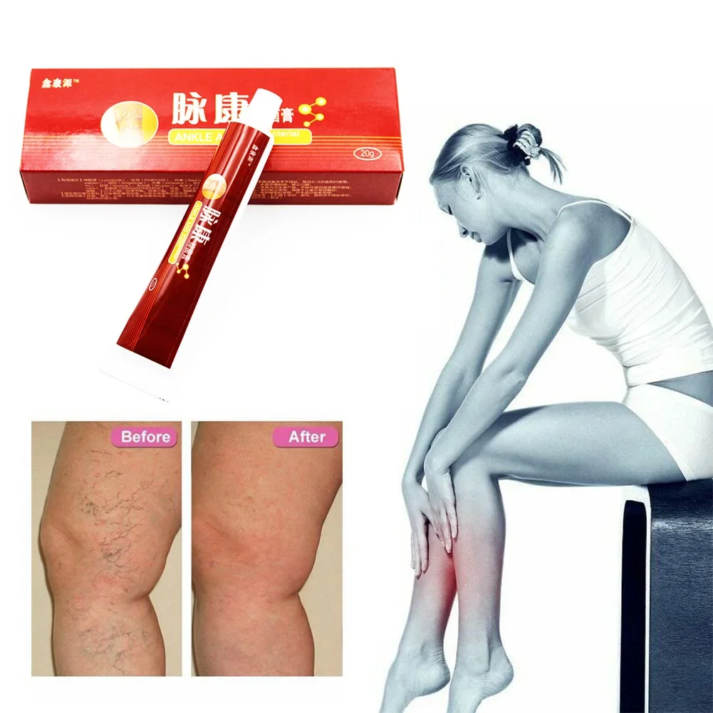 

20g Varicose Veins Treatment Cream Ointment Vasculitis Inflammation Chinese Herbal Leg Massage Varicose Veins Removal Plaster