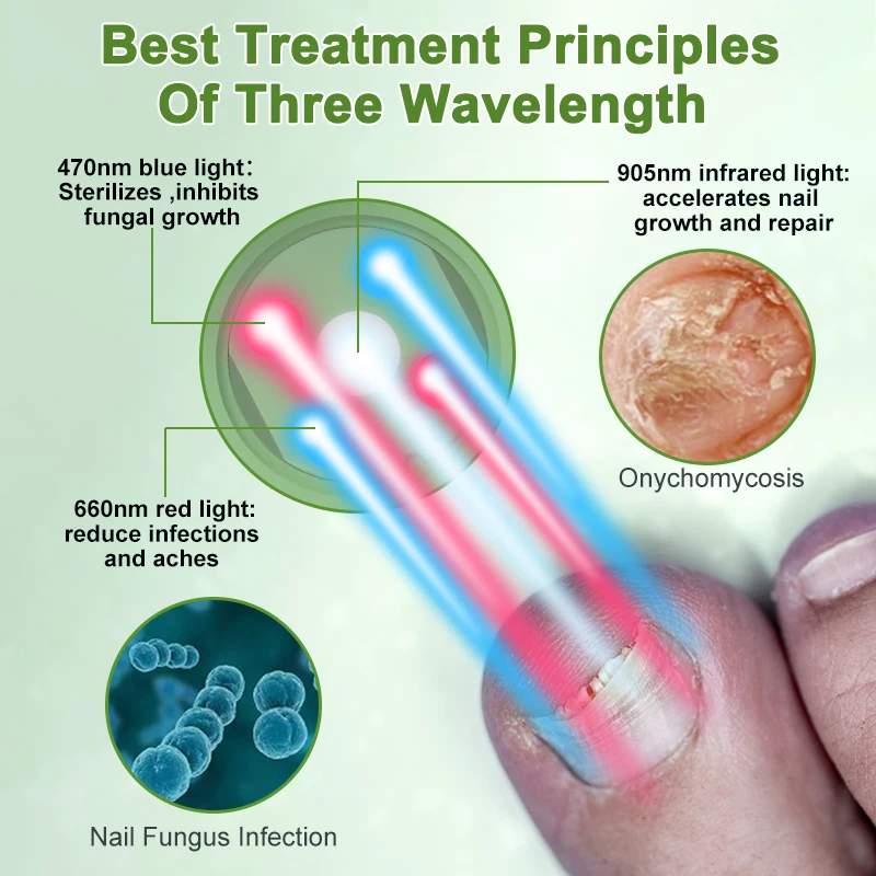 Fungal Nail Laser Treatment Device, Foot Nail Fungus Fast Remove Laser, Toenail Fingernails, No Pain, Physiotherapy for Nails