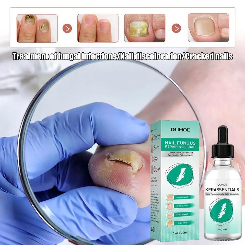 OUHOE 1/3/5PCS Extra Strong Nail Fungus Treatment Serum Essence oil Care Repair Essence Anti Toe Infection Gel Feet Cream
