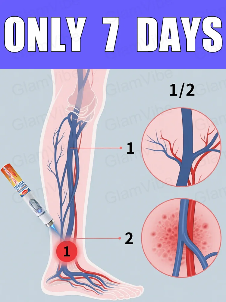 

Generation-2 Laser Says Goodbye To Spider Legs Varicose In 7 Days