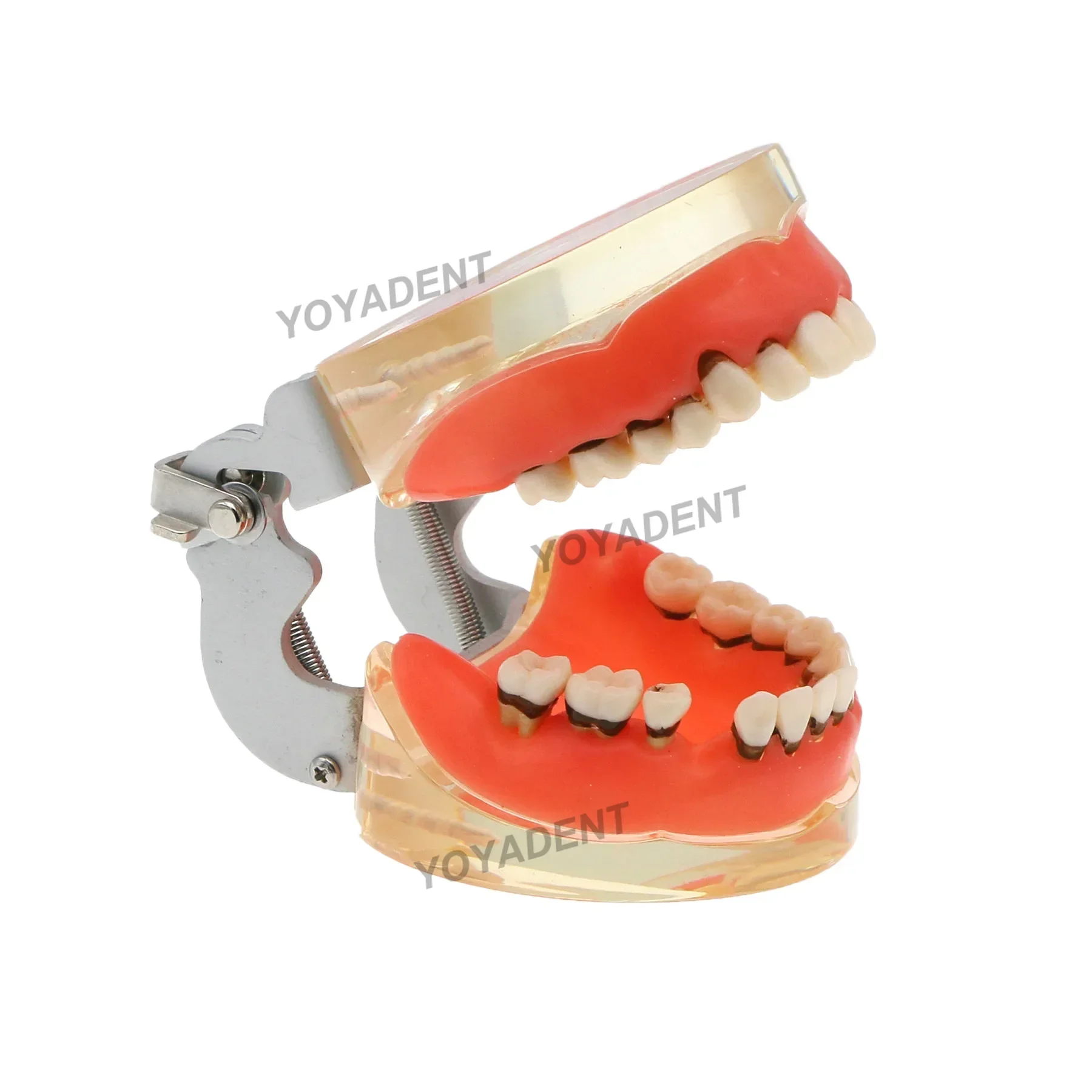 Dental Teeth Model Dentistry Periodontal Disease Pathological Teaching Models For Patient Education Demo Resins Model M4017