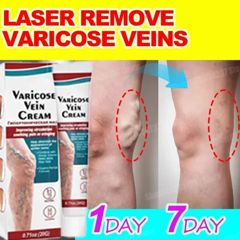 Varicose Vein Cream Spider Vein Pain