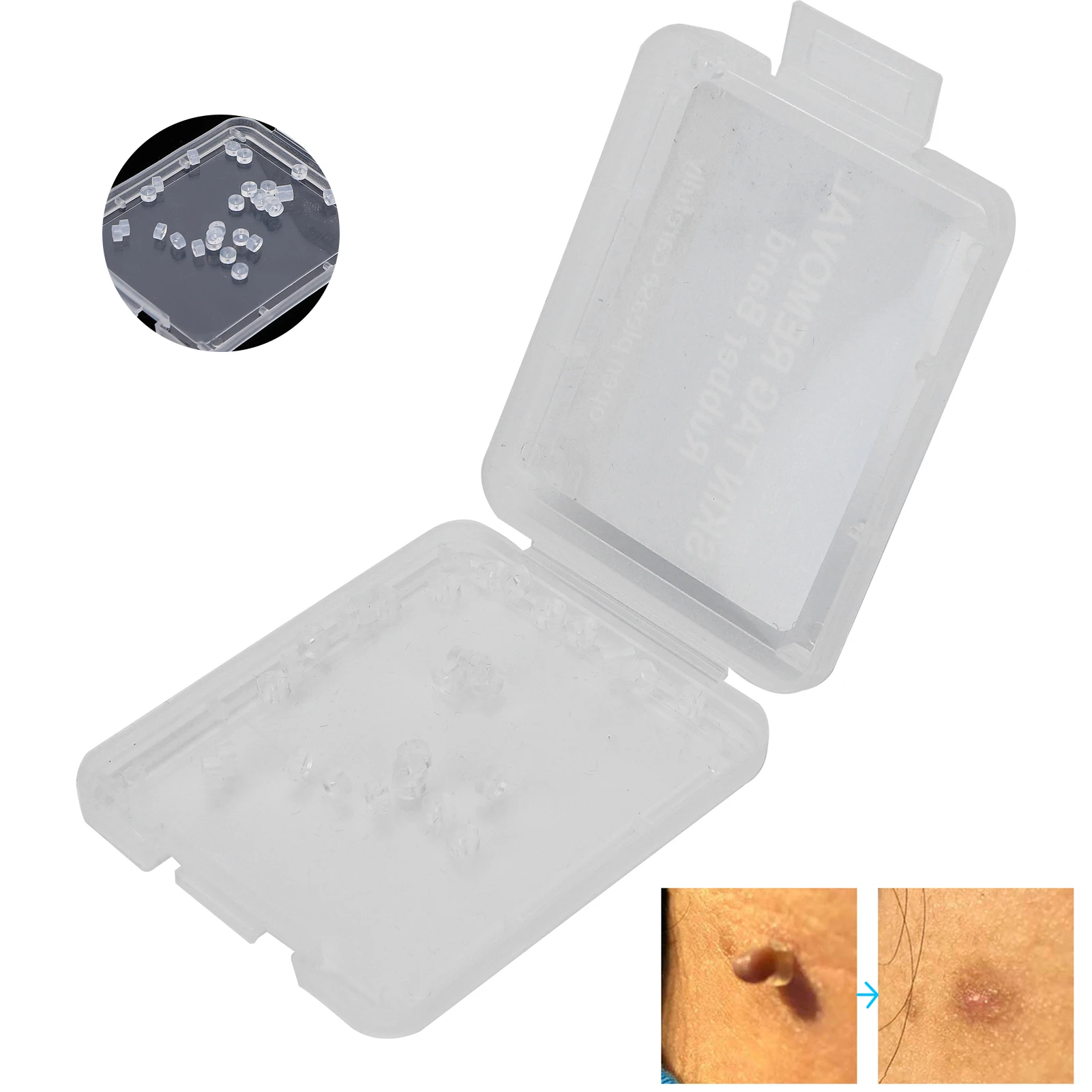 30Pcs Skin Tag Removal Rubber Bands Micro Band Non Toxic Mole Wart Micro Refill Band Skin Tag Removal Bands Skin Care Tools