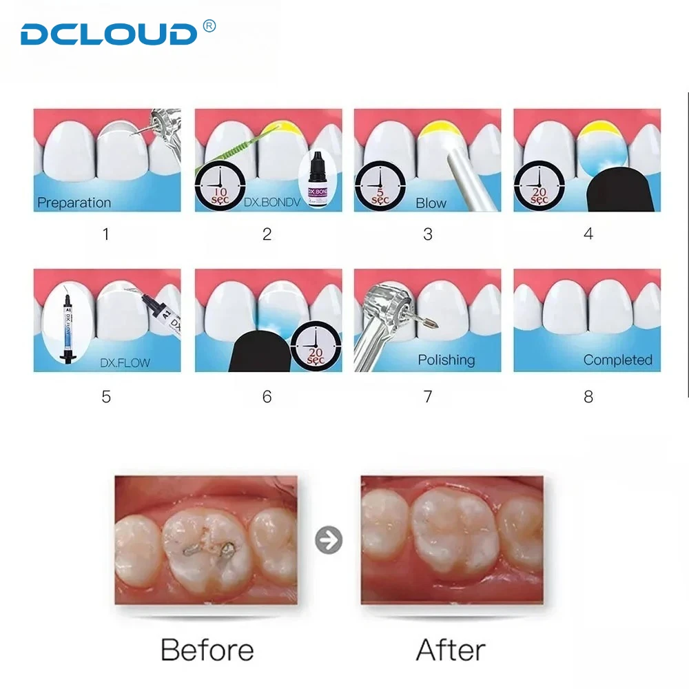 Dentex 3g/Pc Flow Light Curing Dental Composite Resins Teeth Filling Material Micro Hybrid Flowable Resin for Crown Restoration