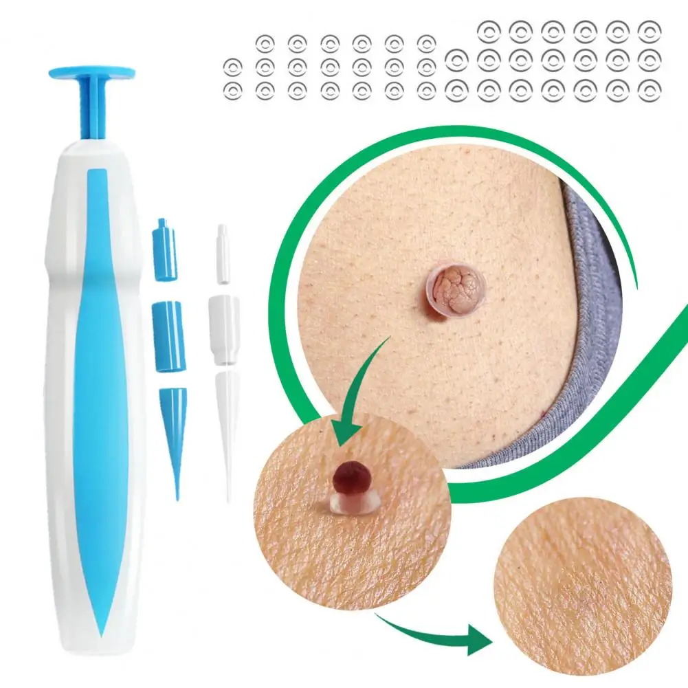 사마귀 제거제 적당한 피부 태그 제거 키트, 아늑한 두더지 제거 세트, 어깨용 두더지 제거 도구, 1 세트