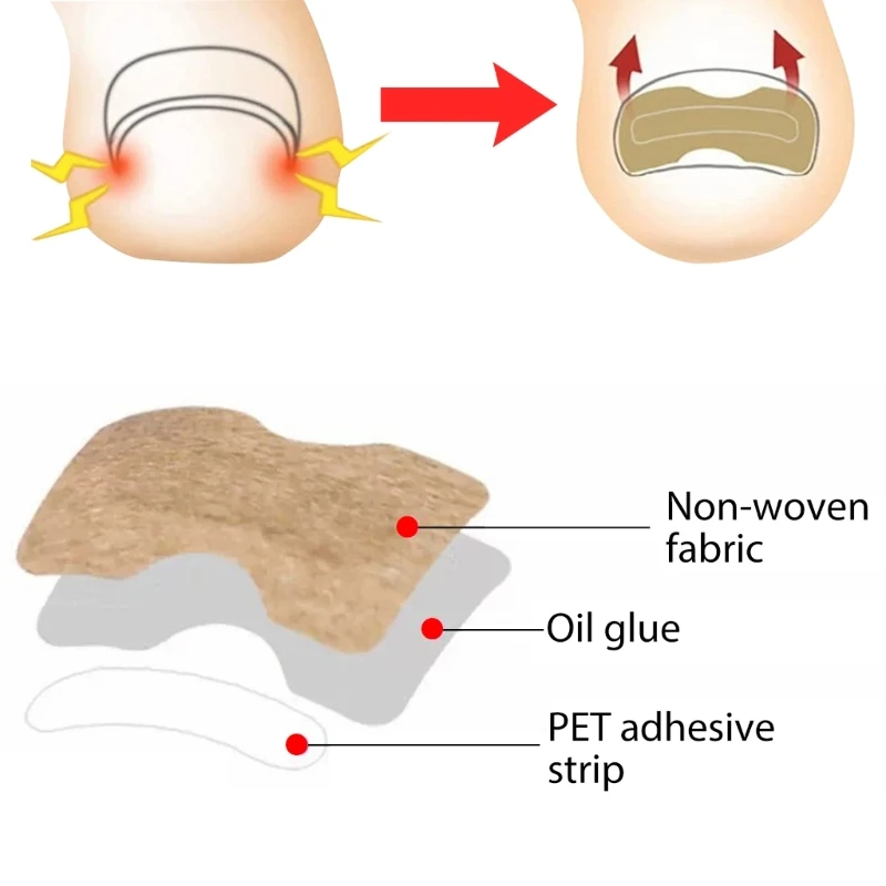 Les patchs correcteurs d'ongles incarnés le tampon remplissage éliminent les ongles ennuyeux, livraison directe