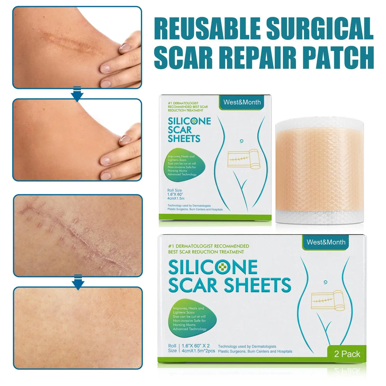 Pasta indolor Silicone Scar Remoção, Repair Tape Roll, Faixa eficaz para C-Seção, Cirurgia quelóide, Cuidados com a pele acne, Queimar acne