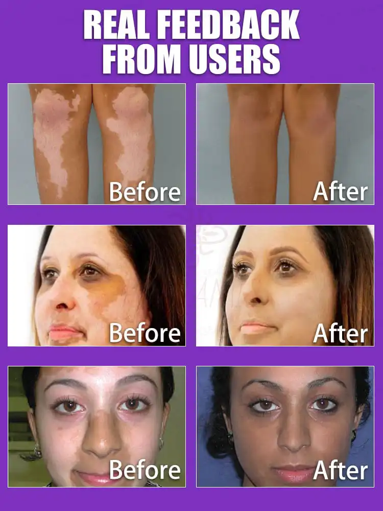 The laser pen is gentle and only acts on the ʷʰⁱᵗᵉ ˢᵖᵒᵗˢ ʷⁱᵗʰᵒᵘᵗ ᵈᵃᵐᵃᵍⁱⁿᵍ ʰᵉᵃˡᵗʰʸ ˢᵏⁱⁿ‧