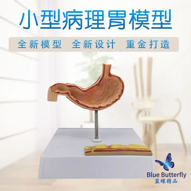 نموذج المعدة المرضية نموذج المعدة المرضية علم الجهاز الهضمي القسم التاوي التوسع التشريحي