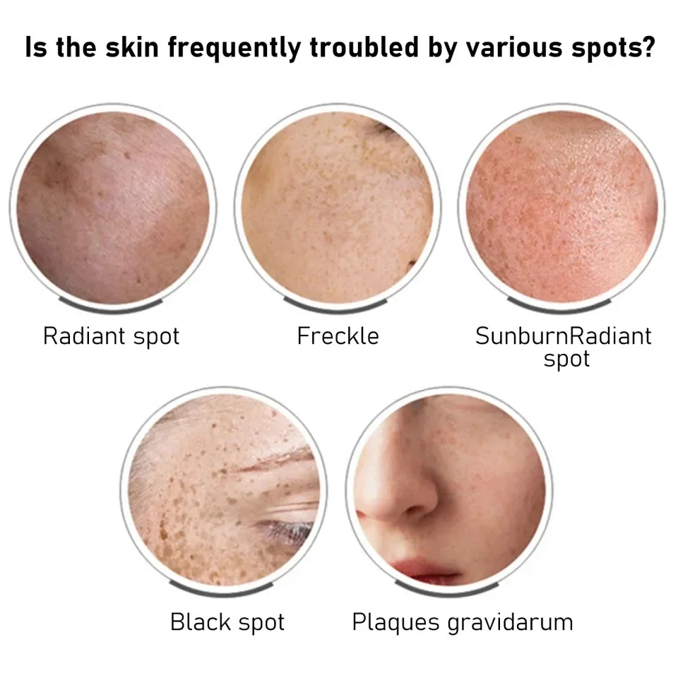 كريم تفتيح الكلف نياسيناميد ، تقليل كريم تفتيح الميلانين ، تفتيح البشرة الداكنة ، سيروم الكلف ، تلاشي خطوط الوجه الدقيقة #4