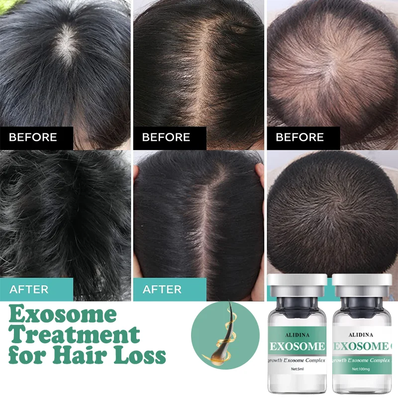 ZS EGF مكافحة تساقط الشعر إعادة نمو بصيلات الشعر إصلاح المغذيات Exosomes مجموعة العناية بفروة الرأس الجذعية نمو الخلايا عامل إعادة نمو الشعر السريع