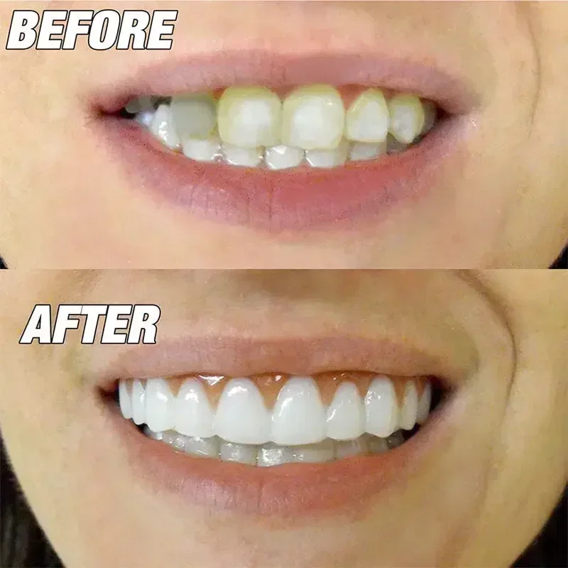 Falsche Zähne, Silikon-Obermaterial, untere Veneers, perfekte Laugh Veneers, Zahnersatz, Paste, künstliche Zähne, Zahnspangen, bequeme Zähne, kieferorthopädisch