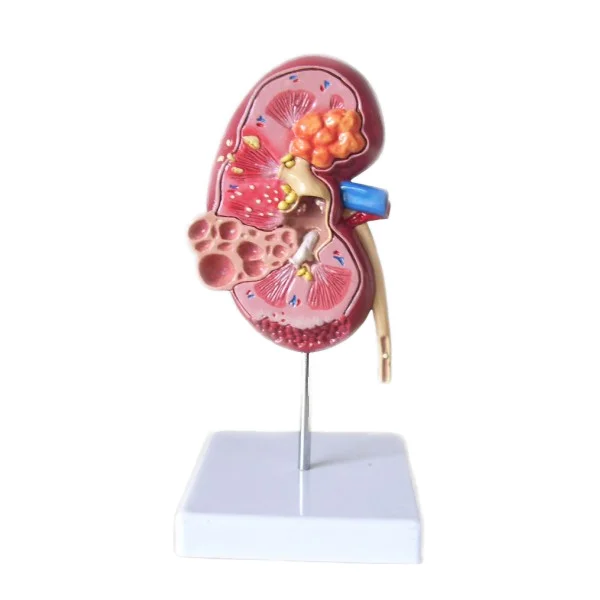 High-quality hot-selling diseased kidney anatomy model