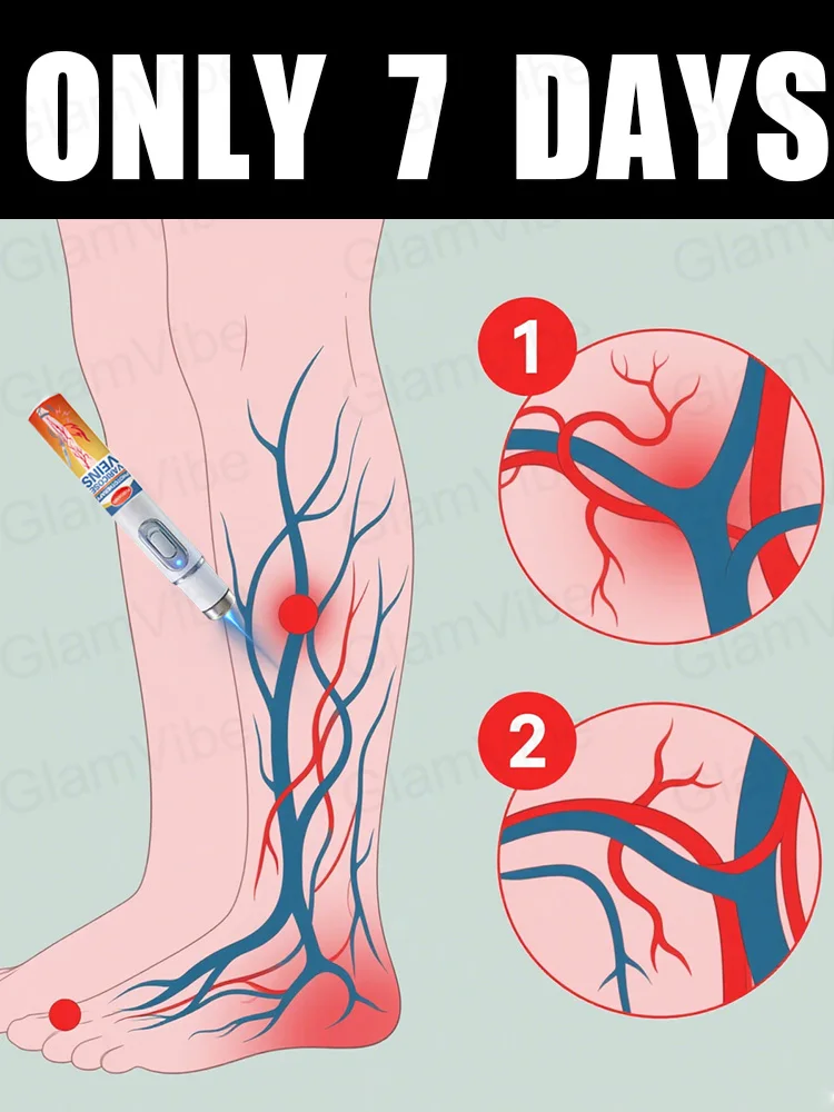 

Generation-2 Laser Says Goodbye To Spider Legs Varicose In 7 Days