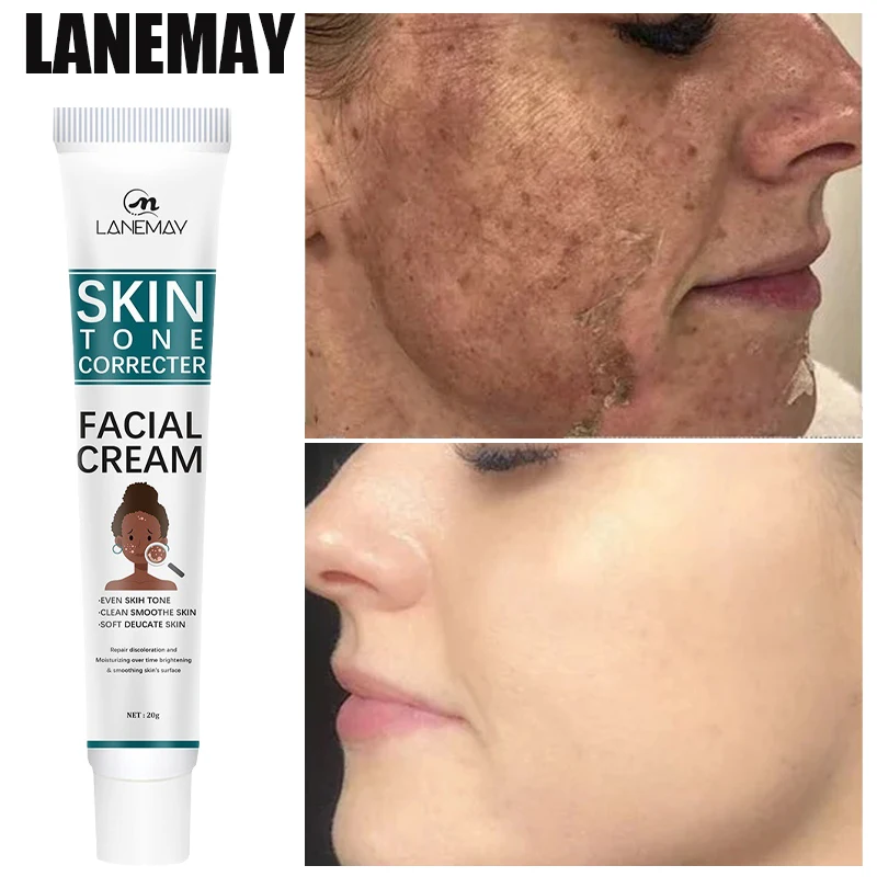 Freckle Removal Cream Face Dark Spot Melasma Remover Lighten Pigmentation Brighten Products Moisturizing Whitening Skin Care