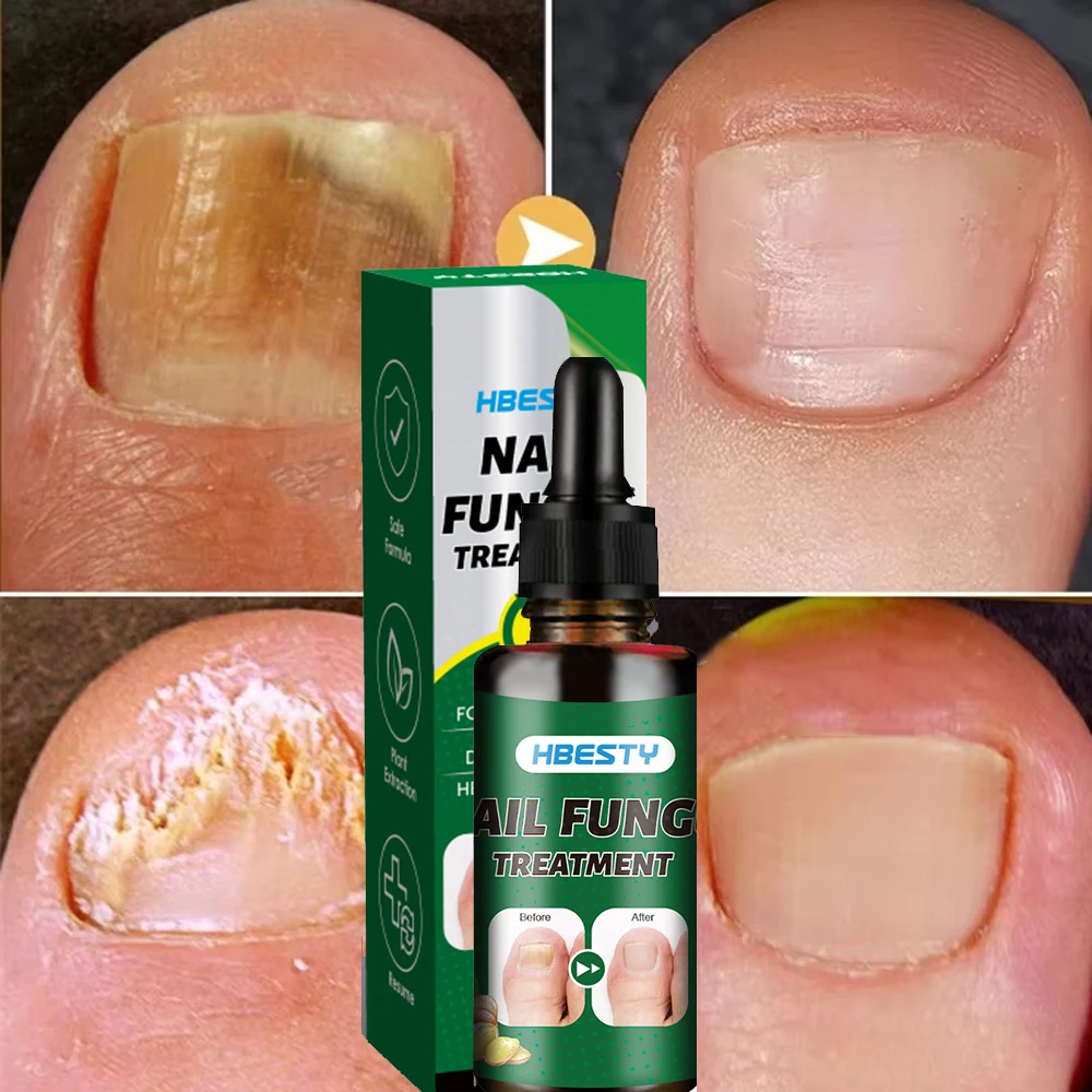 Sérum de réparation fongique des ongles, élimination des champignons des ongles des orteils, huile essentielle, Anti-Infection, Onychomycose, Paronychia, soins réparateurs
