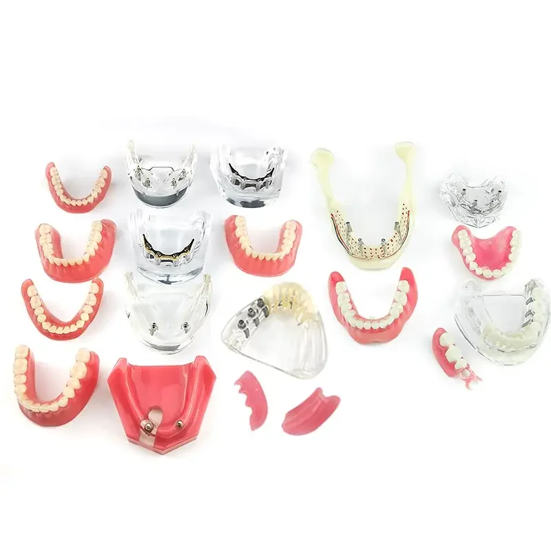 

Dental Overdenture Teeth Model Removable Interior Mandibular Lower Teeth Model Mandibular with Implant for Tooth Teaching Study