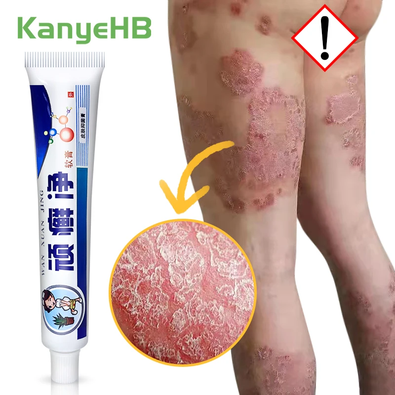 1pcs Skin Psoriasis Cream 100% Original Herbal Plaster Dermatitis Eczematoid Eczema Ointment Treatment Psoriasis Skin Care Cream