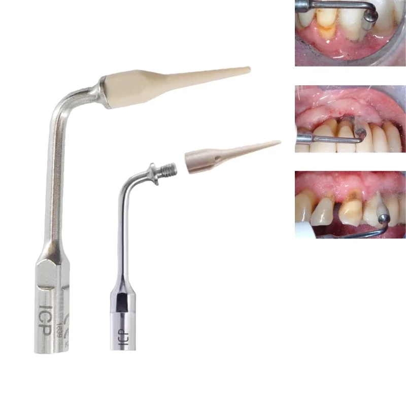 ICP Dental Ultrasonic Scaler Tip Fit Woodpecker/EMS Scaler handpiece Dentistry Cleaning Ceramic Maintenance implanting Peek Tips