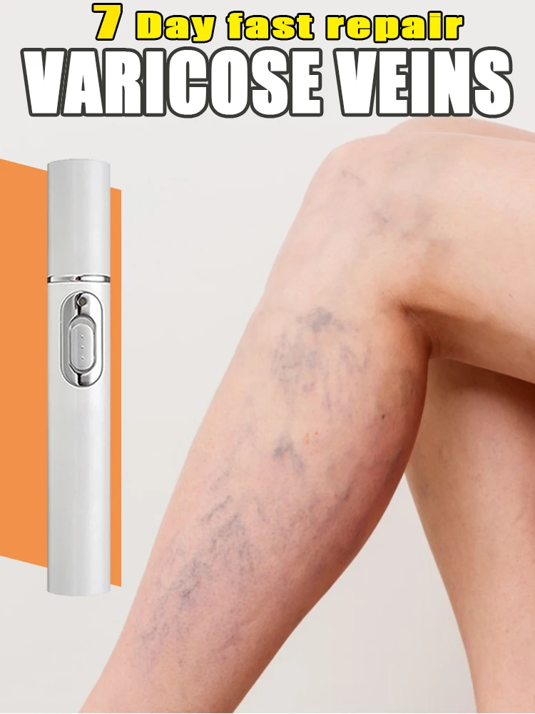 Laser varicose veins, fast repair of spider leg blood vessel dredging