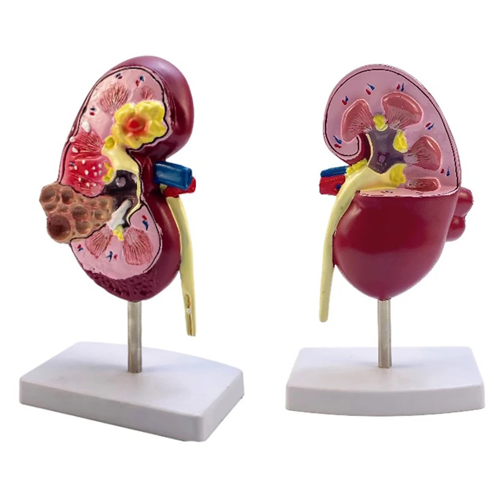 Normal and Pathology Kidney Anatomical Model Diseased Kidney Urinary System Organ Medical Gift Educational Equipment Teaching