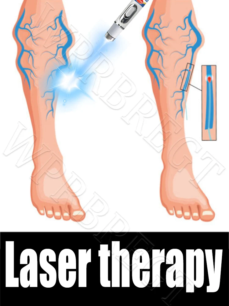 Stylo à veines de 2e génération, traitement indolore des problèmes des jambes, outil de soin des jambes, offre spéciale