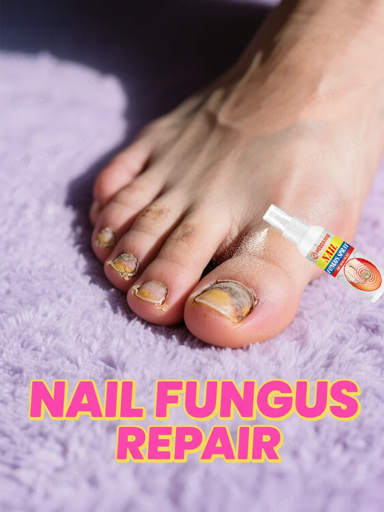 

ᴺᵃⁱˡ ᶠᵘⁿᵍᵘˢ ᵗʳᵉᵃᵗᵐᵉⁿᵗ ᵉˢˢᵉⁿᵗⁱᵃˡ ᵒⁱˡ⸴ ʳᵉᵖᵃⁱʳ ᵒⁿʸᶜʰᵒᵐʸᶜᵒˢⁱˢ ⁱⁿ ⁷ ᵈᵃʸˢ